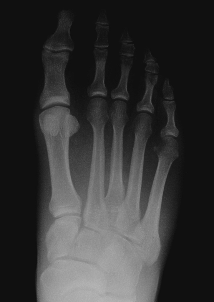 stress fracture, foot, xray, denver, lone tree, podiatrist, foot surgeon. ankle surgery